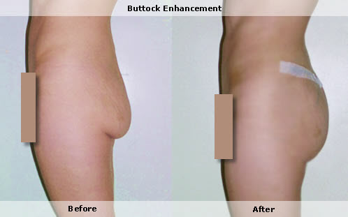 Buttock implants,butt augmentation